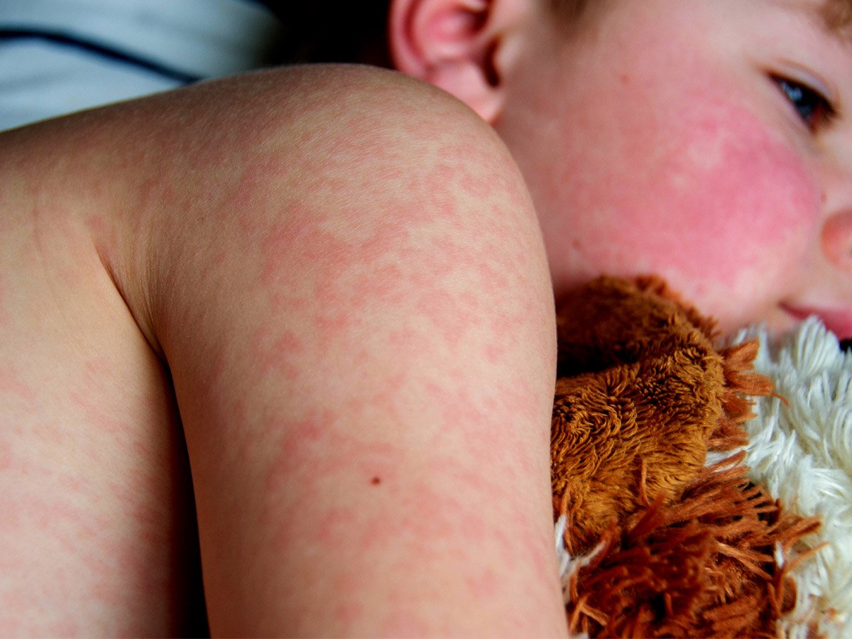 الحكيم-فرات--الشرية-عند-الأطفال