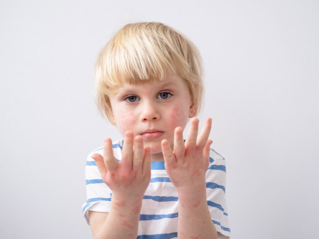 الحكيم-فرات-حساسيات-الطعام-عند-الأطفال