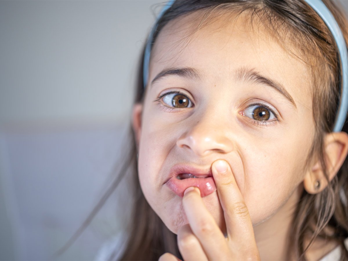 الحكيم فرات- حساسيات الفم عند الأطفال