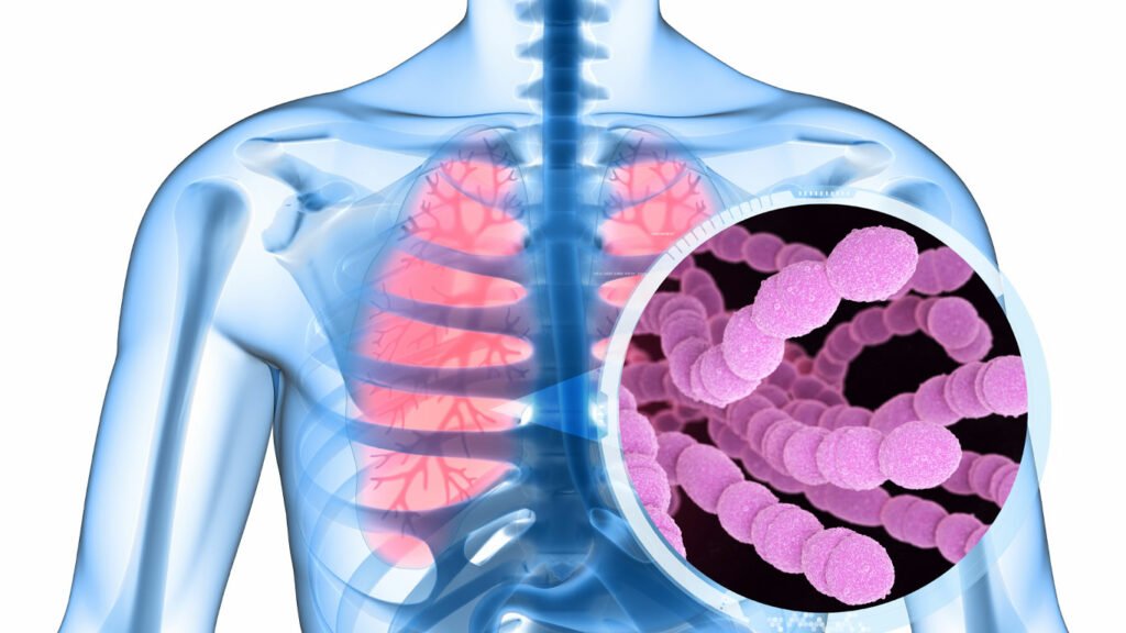 التهاب-المكورات-الرئوية