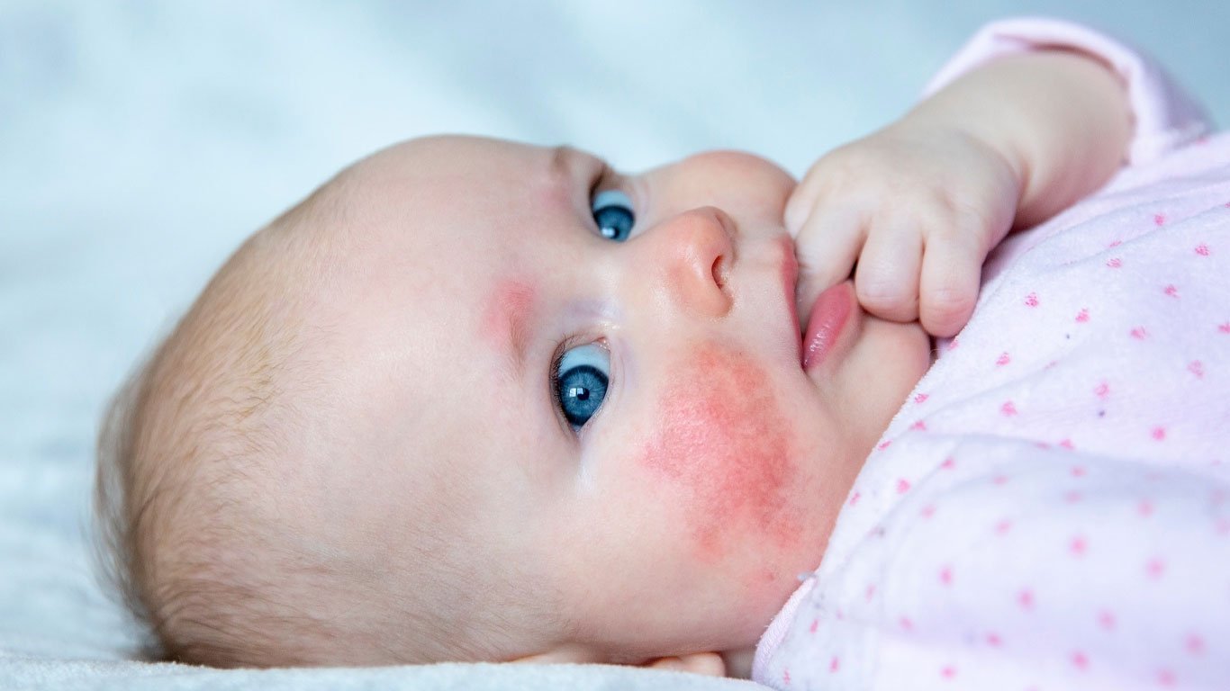 الحمى-القرمزية