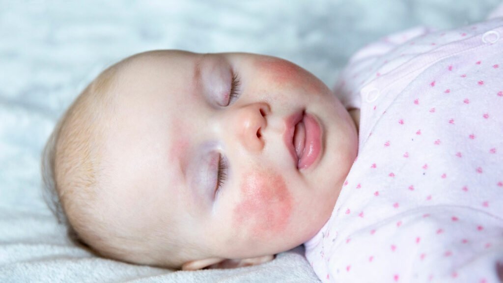 الحمى-القرمزية